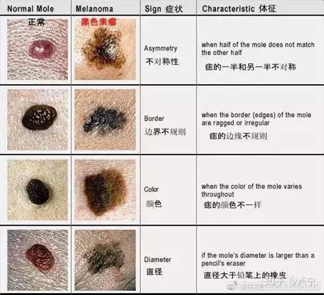 痣 顏色|痣形成的原因？痣長毛、痣變多變大是痣病變？5招判。